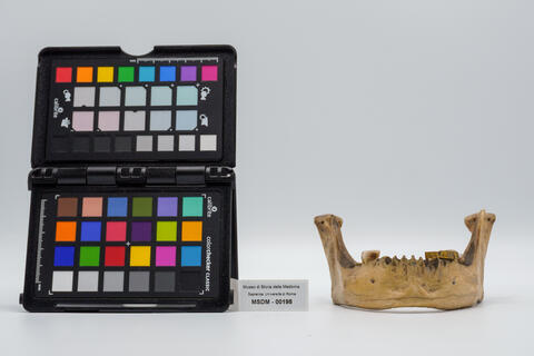 calco di protesi dentaria 00198 photo