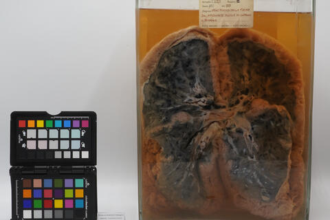 Preparato anatomico di mesotelioma polmonare 2504 photo