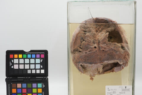 Preparato anatomico di polmone con caverna tubercolare 2506 photo