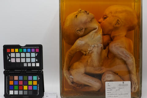 Gemelli toracopaghi 2513 photo