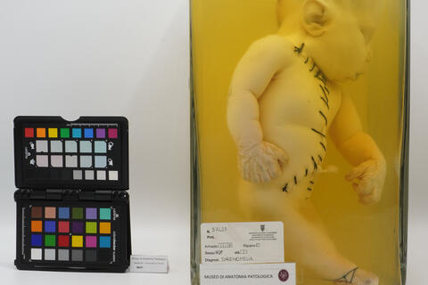 Preparato anatomico-diagnosi di sirenomelia 2518 photo