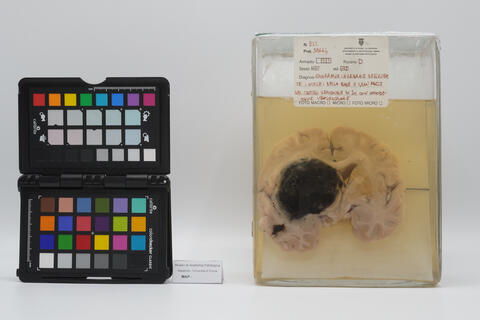 Preparato anatomico di cervello con emorragia cerebrale 2521 photo