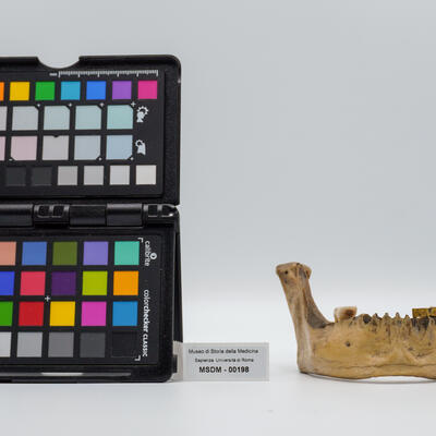 calco di protesi dentaria 00198 photo