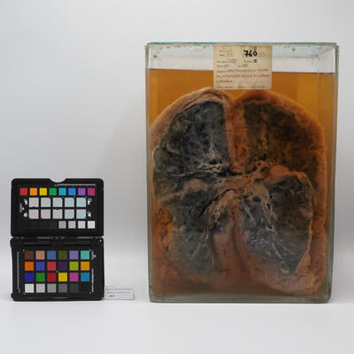 Preparato anatomico di mesotelioma polmonare 2504 photo