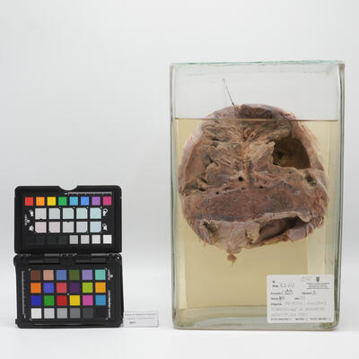 Preparato anatomico di polmone con caverna tubercolare 2506 photo