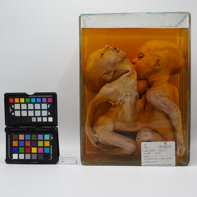 Gemelli toracopaghi 2513 photo