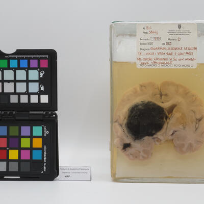 Preparato anatomico di cervello con emorragia cerebrale 2521 photo