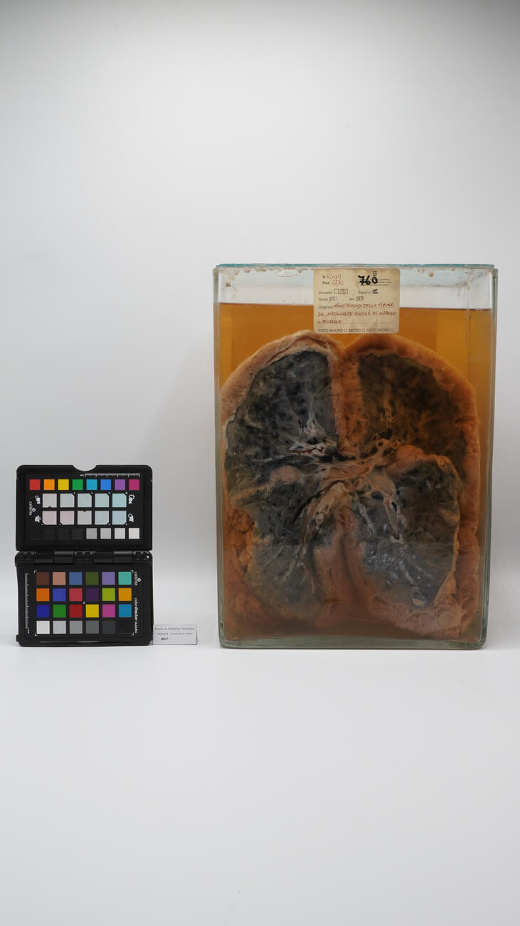 Preparato anatomico di mesotelioma polmonare 2504 photo