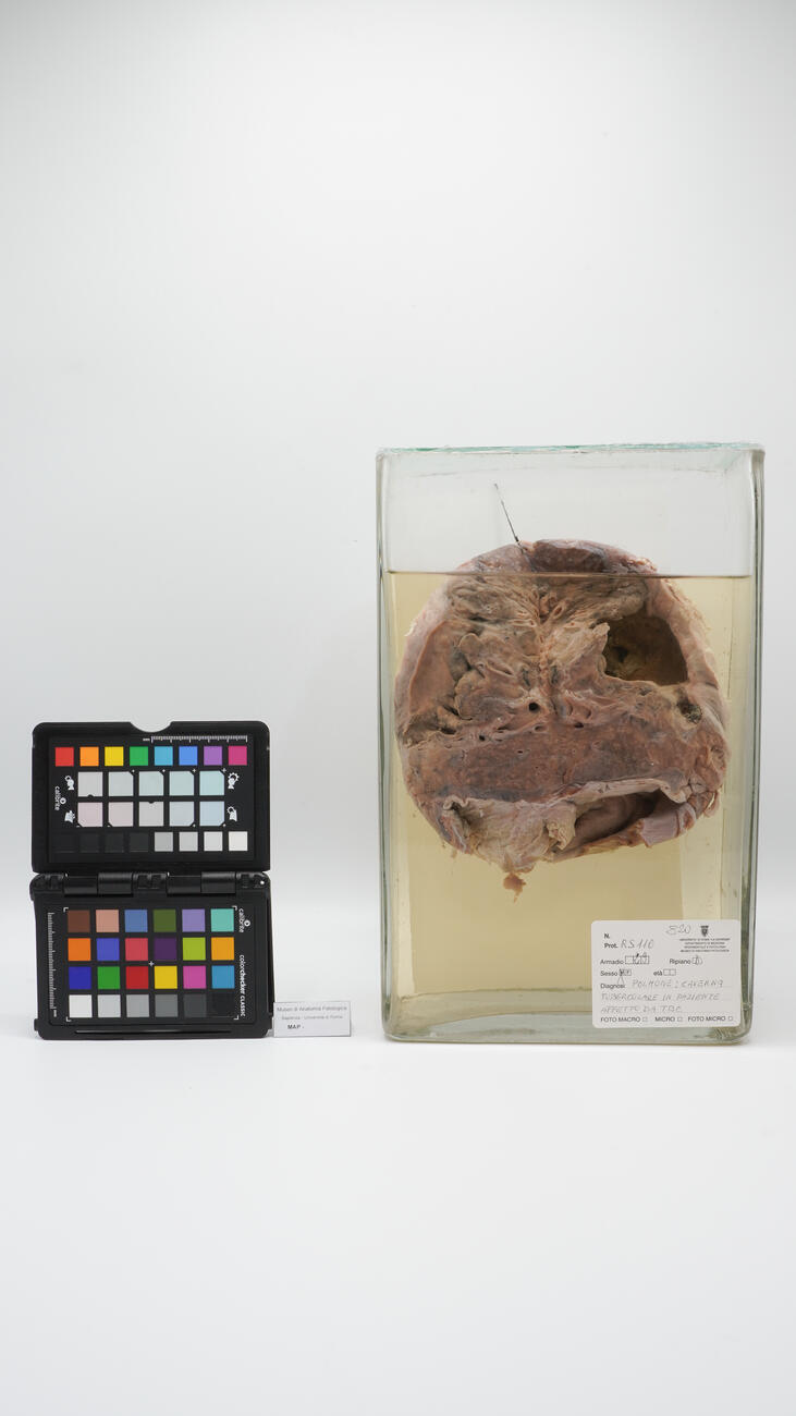 Preparato anatomico di polmone con caverna tubercolare 2506 photo