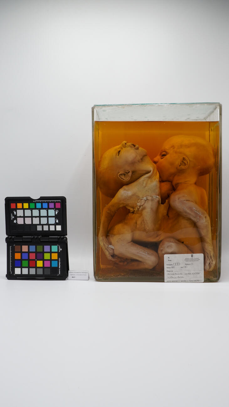 Gemelli toracopaghi 2513 photo