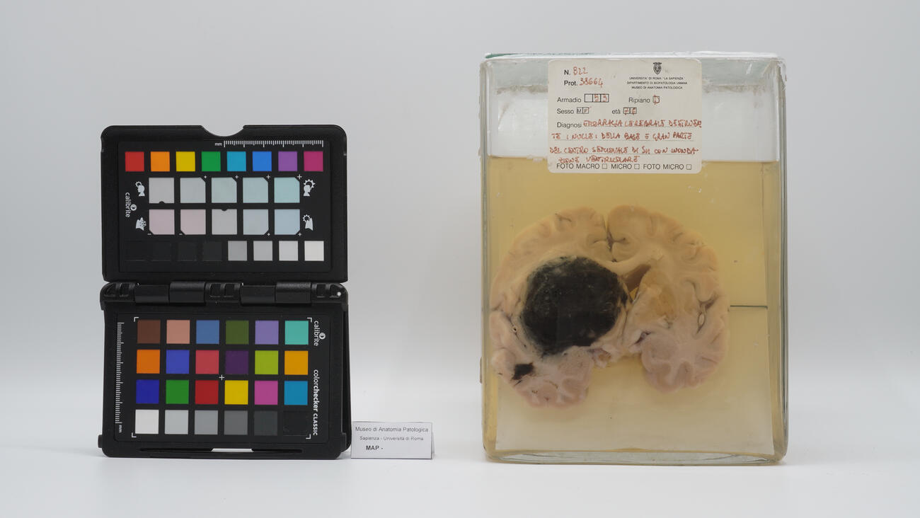 Preparato anatomico di cervello con emorragia cerebrale 2521 photo